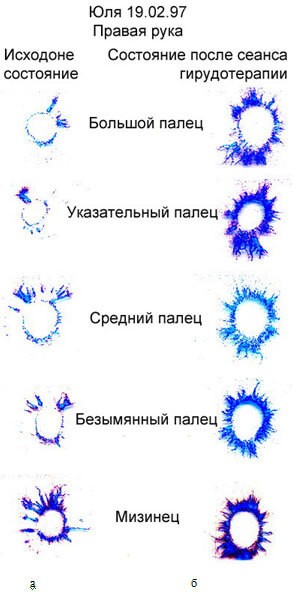 Природа массоэнергоинформационных взаимодействий в гирудотерапии